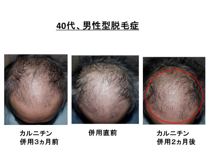 円形脱毛症　病院